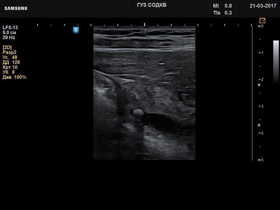 Choledochus - gallstone, B-mode (echogramm №733)