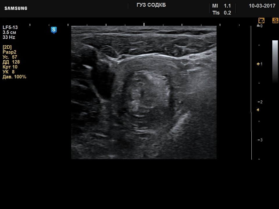 Intestines - intussusception, B-mode (echogramm №735)