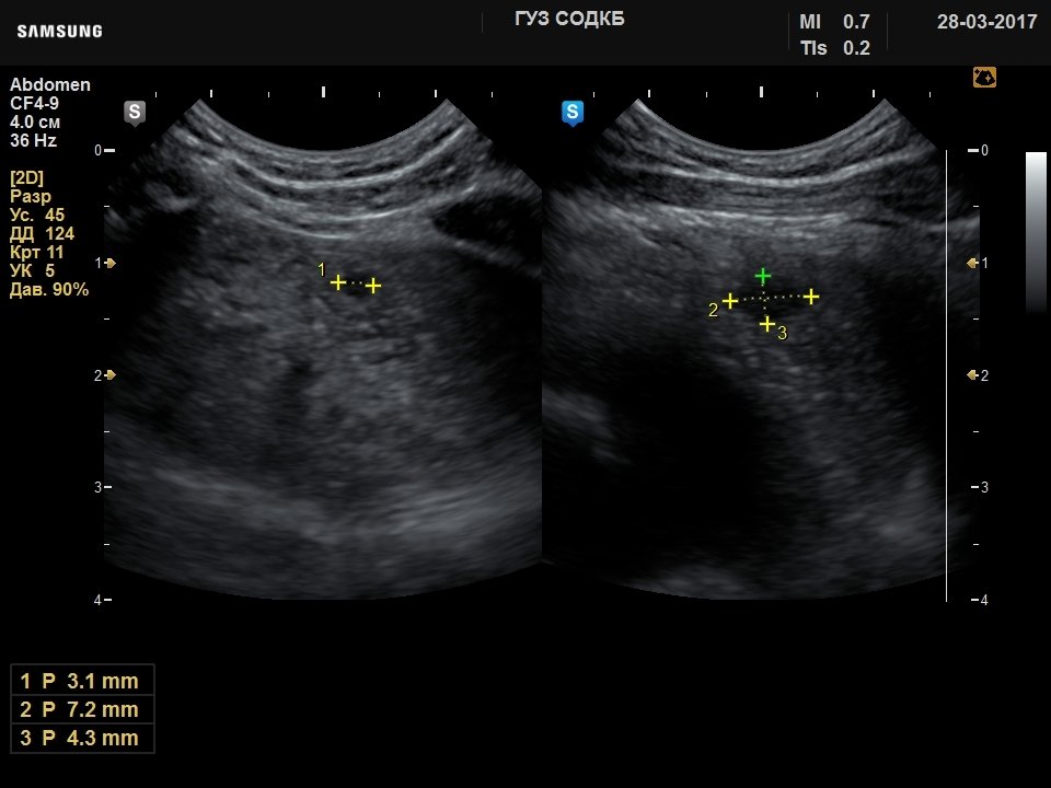 Thymus - cyst, B-mode (echogramm №736)