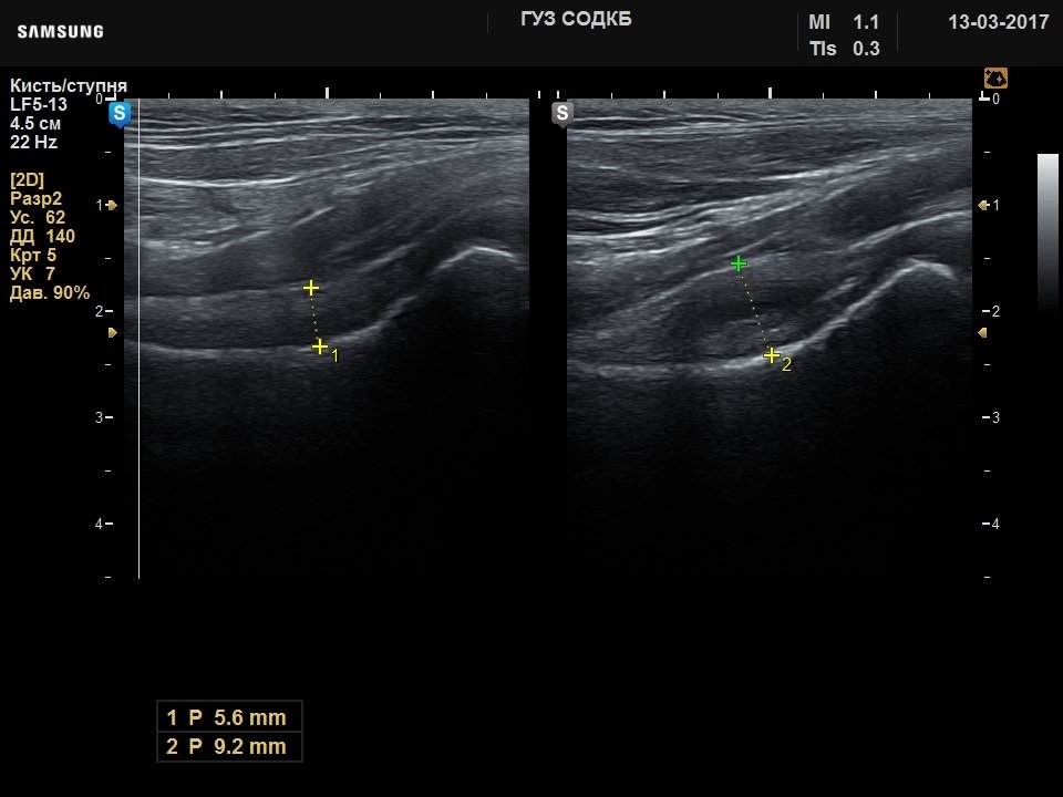 Hip joint - inflammation, B-mode (echogramm №737)