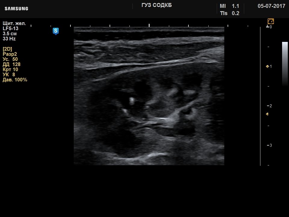 Kidney - small stones, B-mode (echogramm №739)