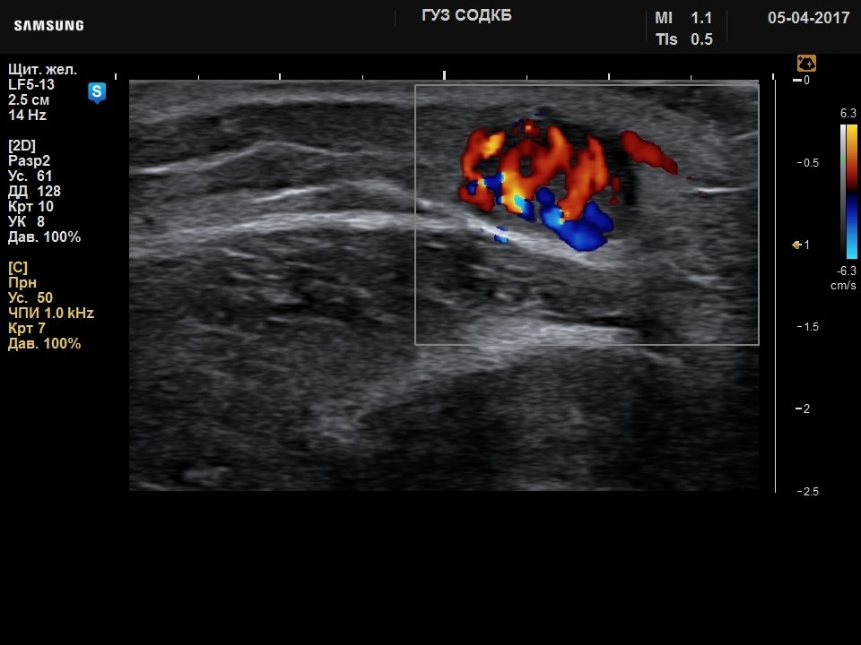 Forearm - soft tissue lesion, color doppler (echogramm №740)