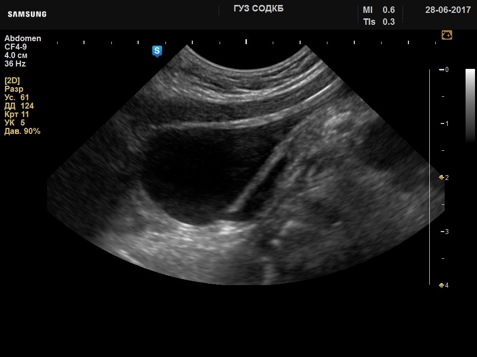 Urinary bladder - dilated ureter, B-mode (echogramm №741)