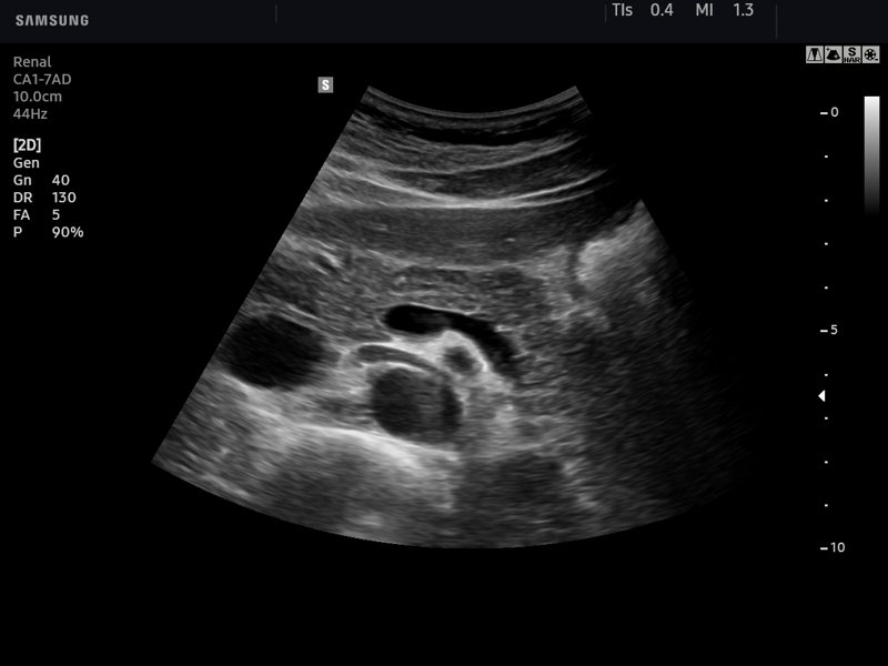 Pancreas, B-mode (echogramm №743)