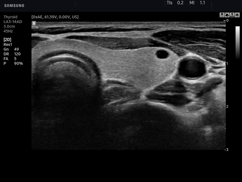 Thyroid, B-mode (echogramm №744)