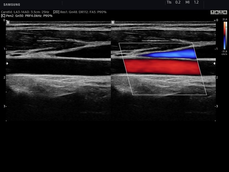 Common carotid artery, color doppler (echogramm №747)