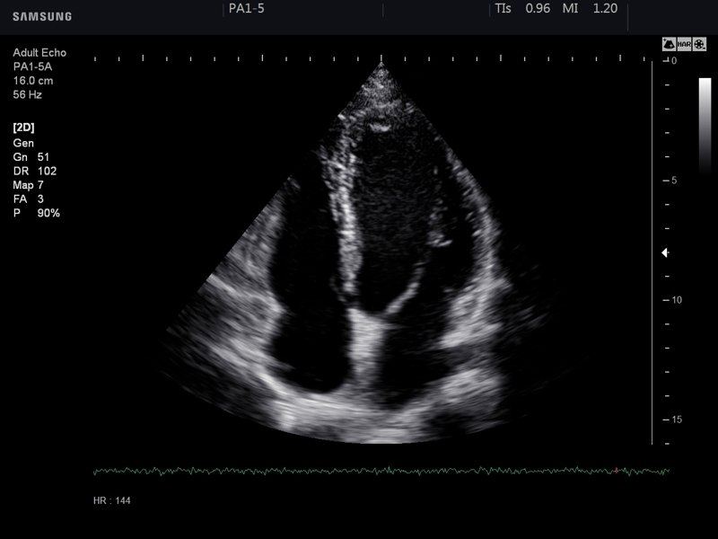 Heart (4 chamber view), B-mode (echogramm №748)