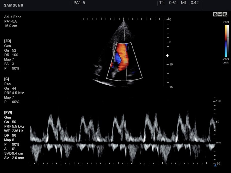 Mitral valve, CFM & PW (echogramm №749)