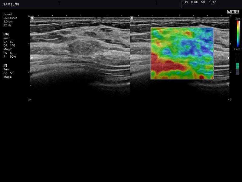 Breast, Elastoscan (echogramm №751)