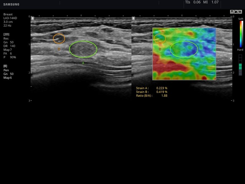 Breast, E-Strain™ (echogramm №752)