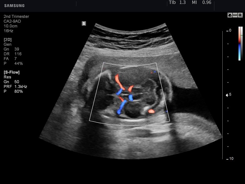 Fetus - brain vessels, S-Flow (echogramm №753)