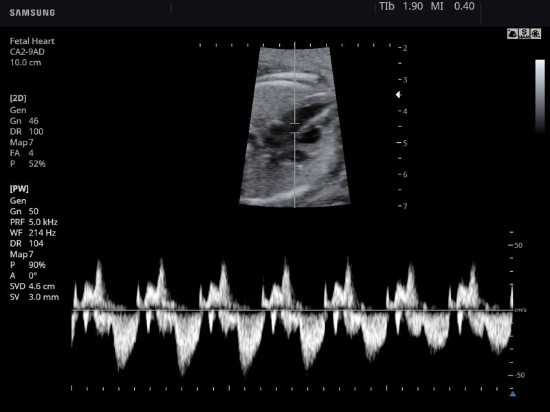 Fetal heart, CFM & PW (echogramm №756)