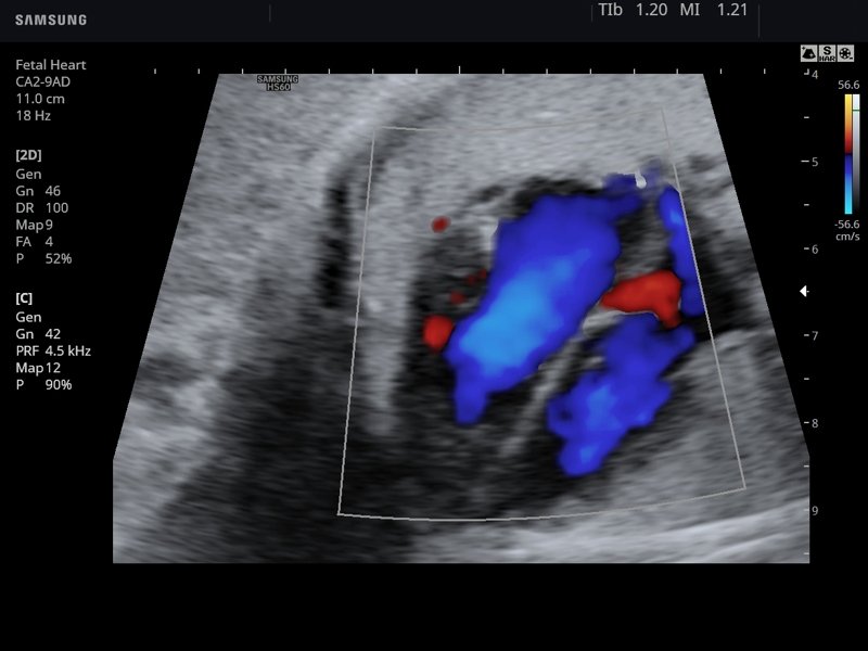 Fetal heart, color doppler (echogramm №757)