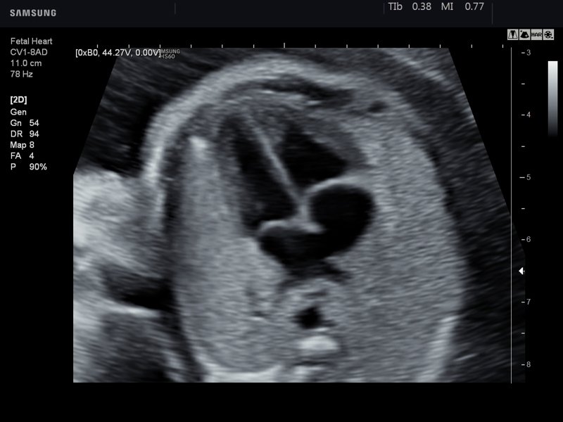 Fetal heart (4 chamber view), B-mode (echogramm №758)