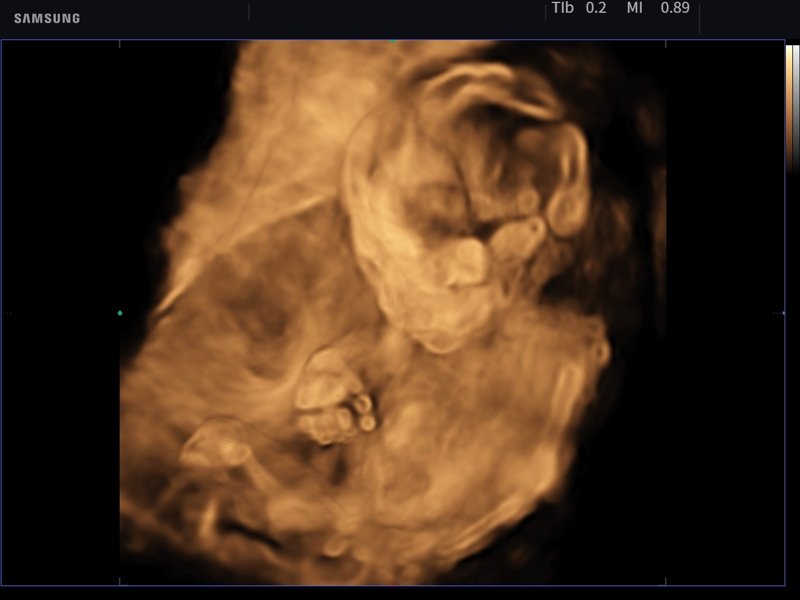 Fetus - 21 weeks, Crystal Vue, 3D (echogramm №759)