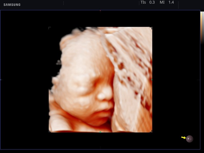 Fetus - face, Realistic Vue, 3D (echogramm №760)