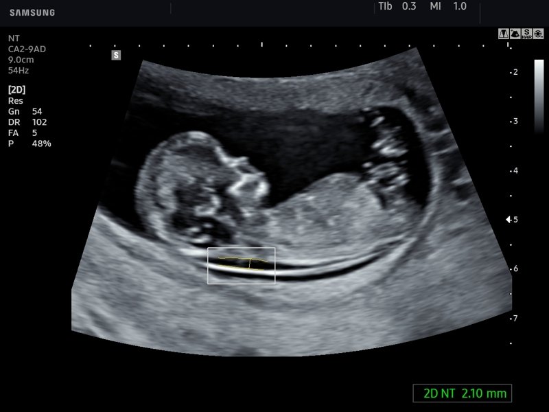 Fetus - nuchal translucency, 2D NT (echogramm №761)