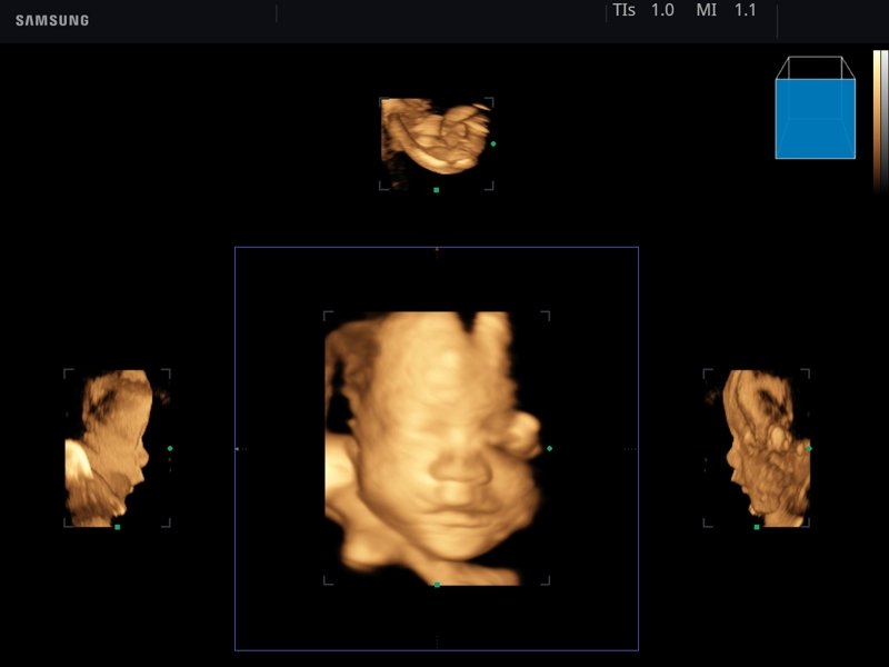 Fetus, Mirror View, 3D (echogramm №762)