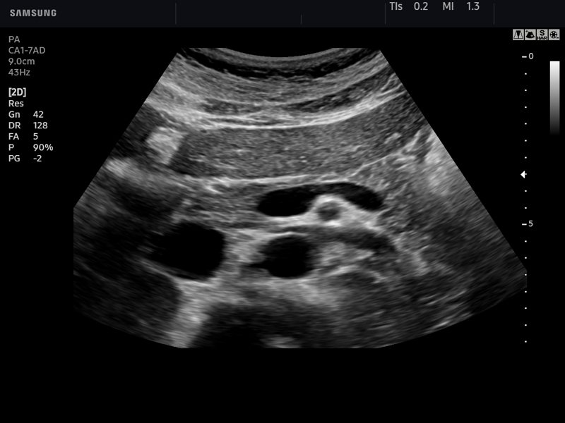 Pancreas, B-mode (echogramm №764)