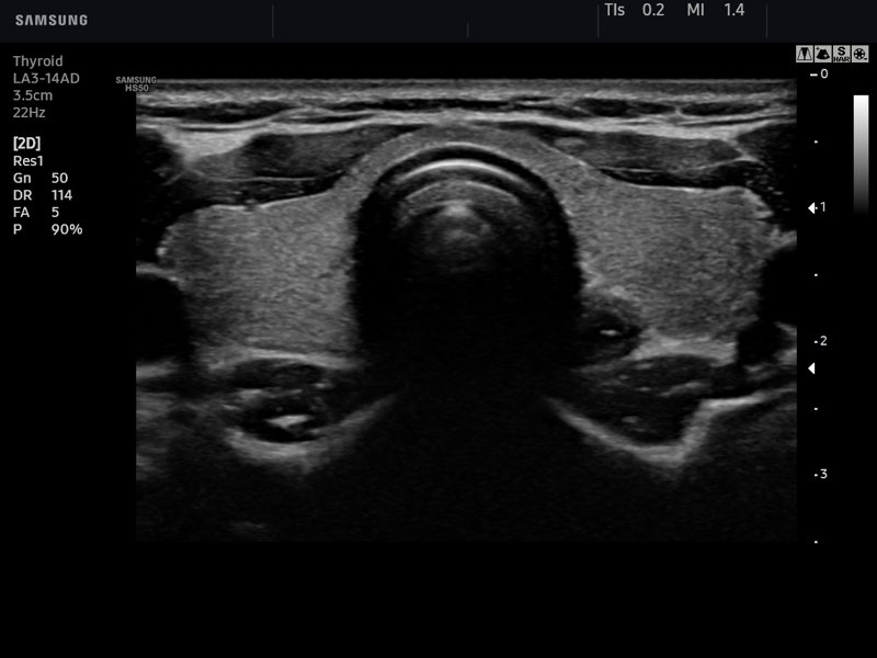 Thyroid, B-mode (echogramm №766)