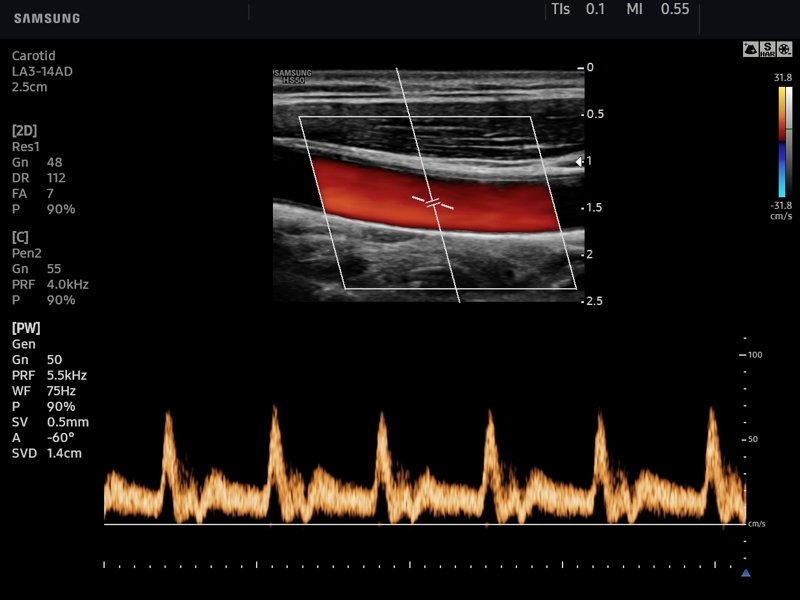 Common carotid artery, CFM & PW (echogramm №768)