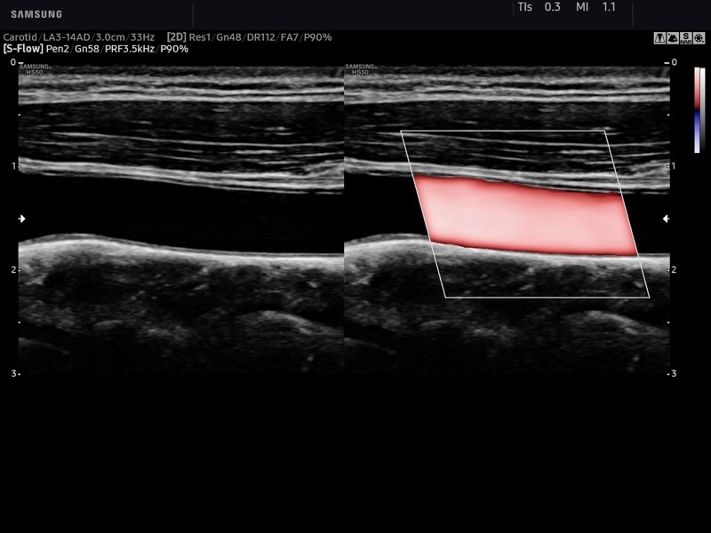Common carotid artery, S-Flow™ (echogramm №769)