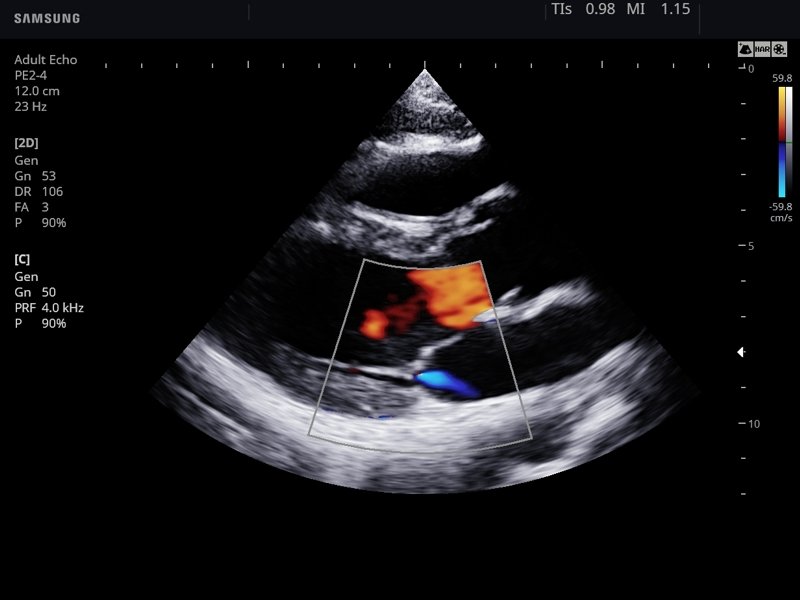 Heart, color doppler (echogramm №770)