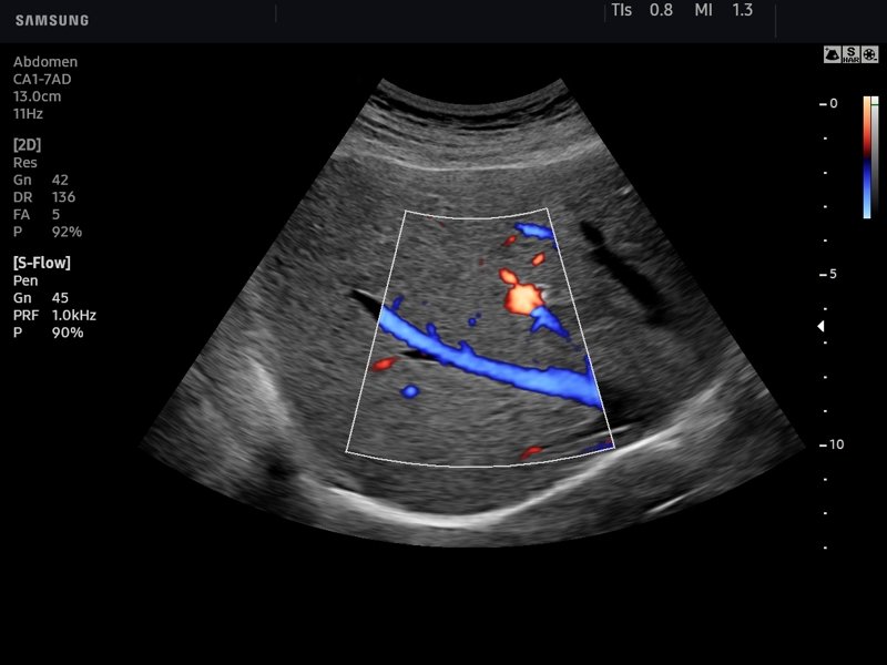 Liver, S-Flow™ (echogramm №771)