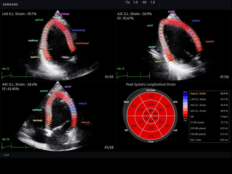 Heart, Strain+ (echogramm №772)