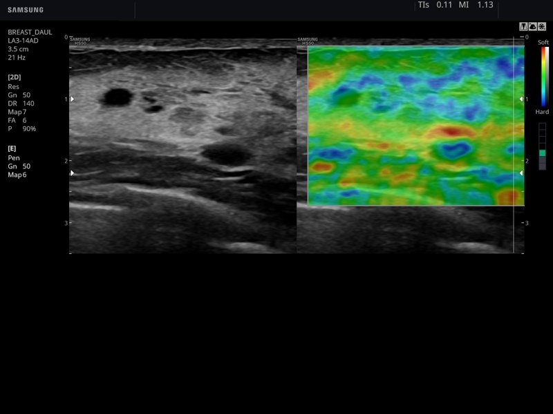 Breast, Elastoscan (echogramm №774)