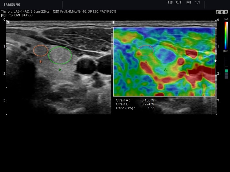 Thyroid, E-Strain™ (echogramm №775)