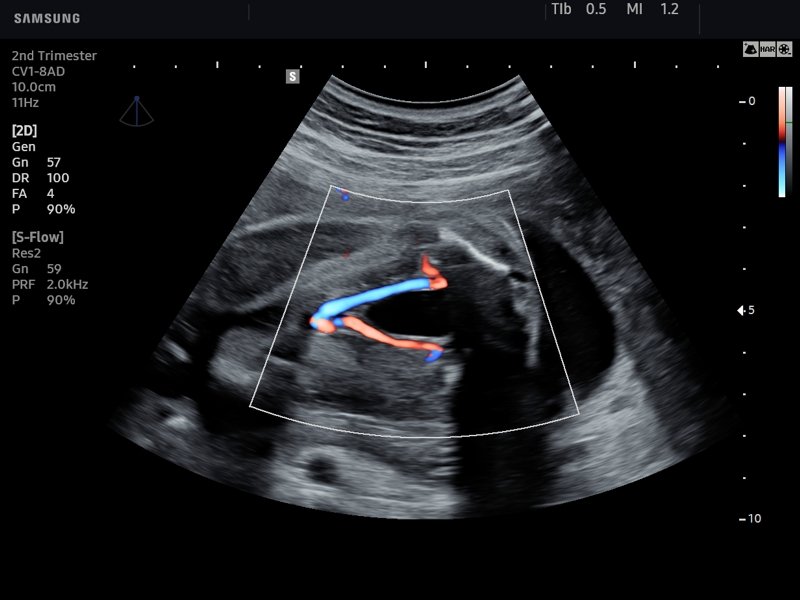 Umbilical artery, S-Flow (echogramm №777)