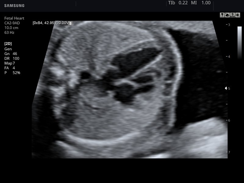 Fetal heart, B-mode (echogramm №778)