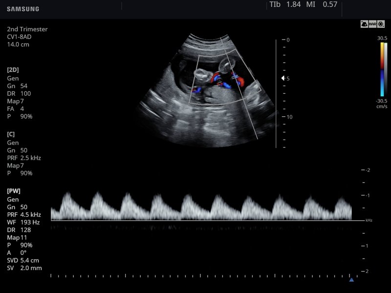 Umbilical cord, CFM & PW (echogramm №779)