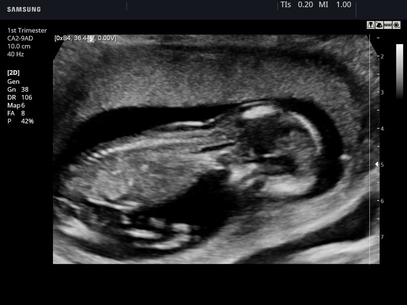 Fetus (1-st trimester), B-mode (echogramm №780)