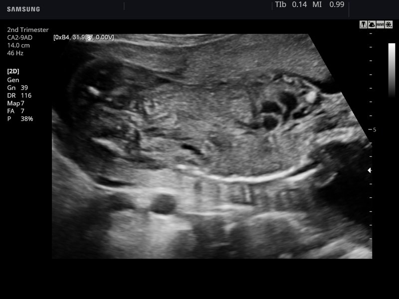 Fetal abdomen, B-mode (echogramm №781)