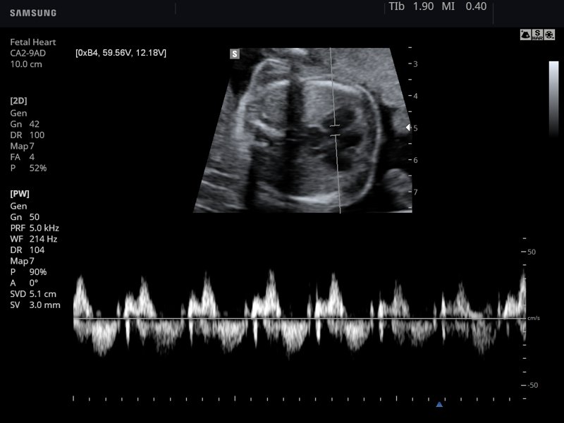 Fetal heart, PW doppler (echogramm №782)