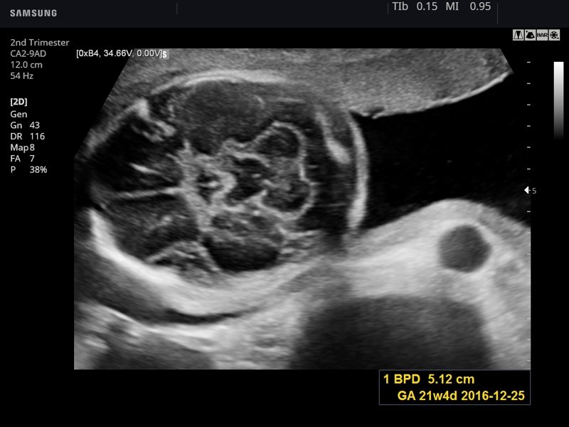 Fetal brain, B-mode (echogramm №783)