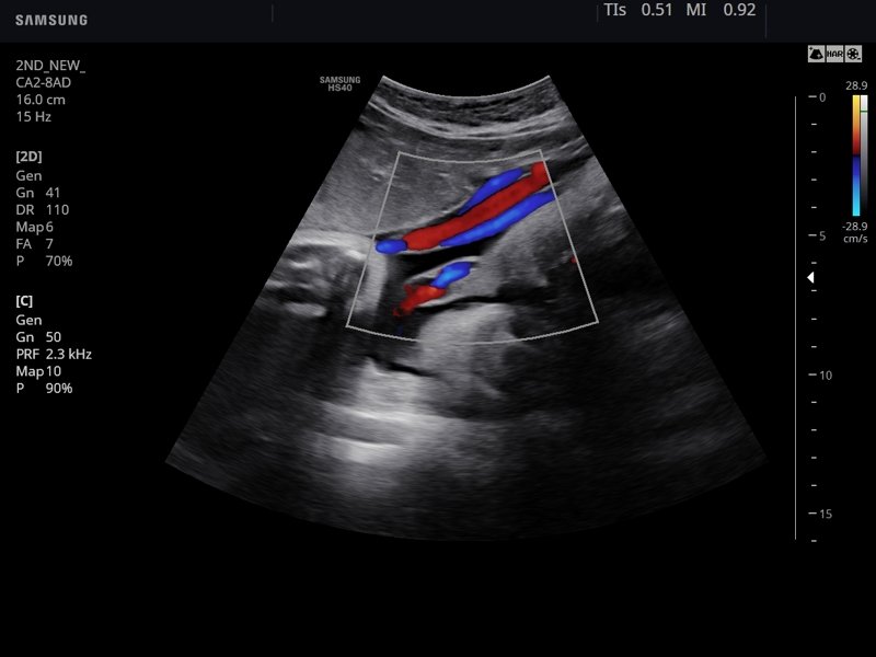 Umbilical cord, color doppler (echogramm №784)