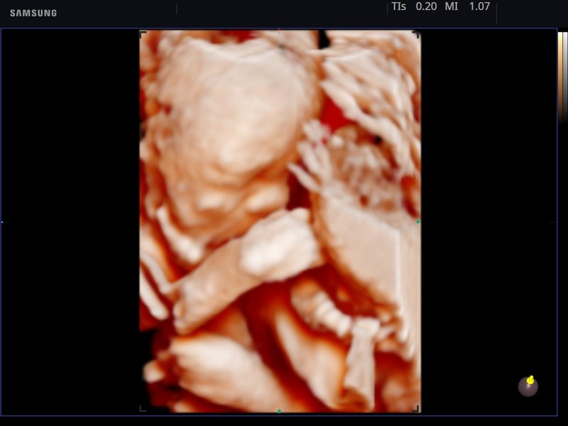 Fetus, Realistic Vue, 3D (echogramm №786)