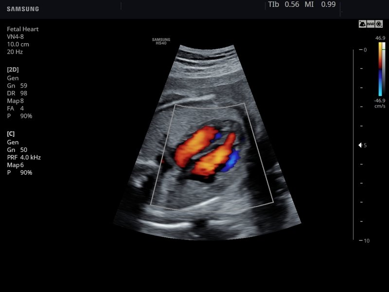 Fetal heart, color doppler (echogramm №787)