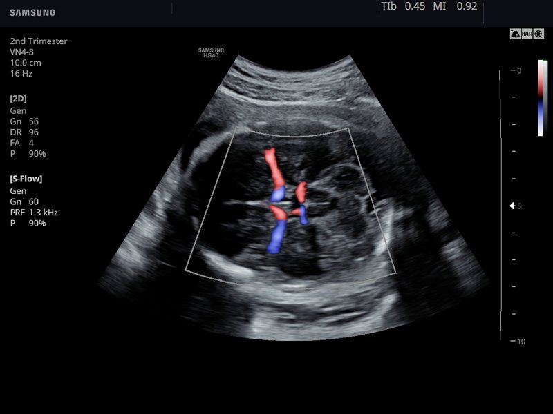 Fetal brain, S-Flow (echogramm №788)