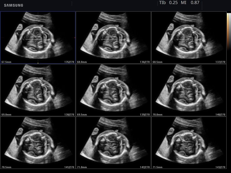 Fetal brain, MSV (echogramm №789)