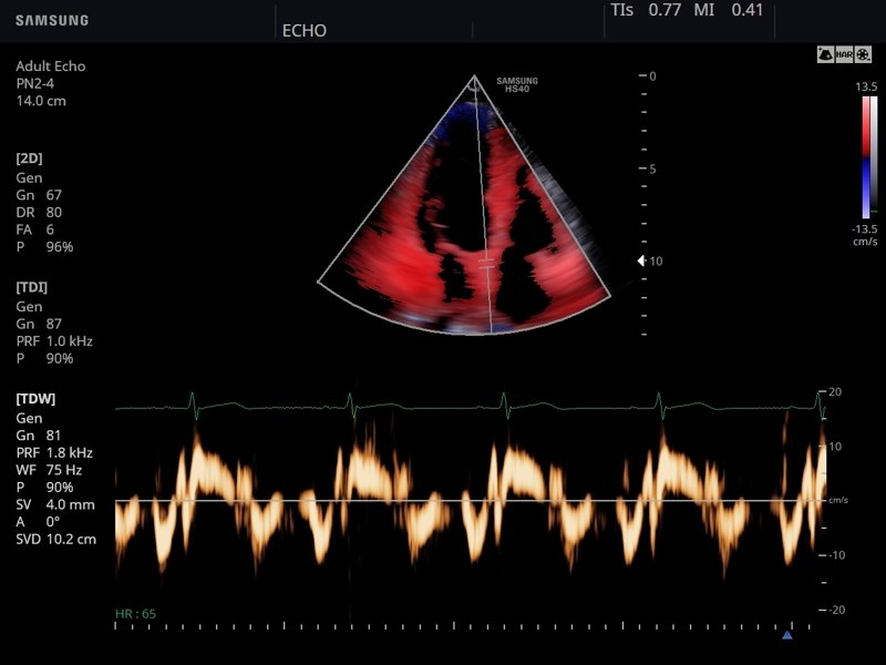 Heart, tissue doppler (echogramm №791)