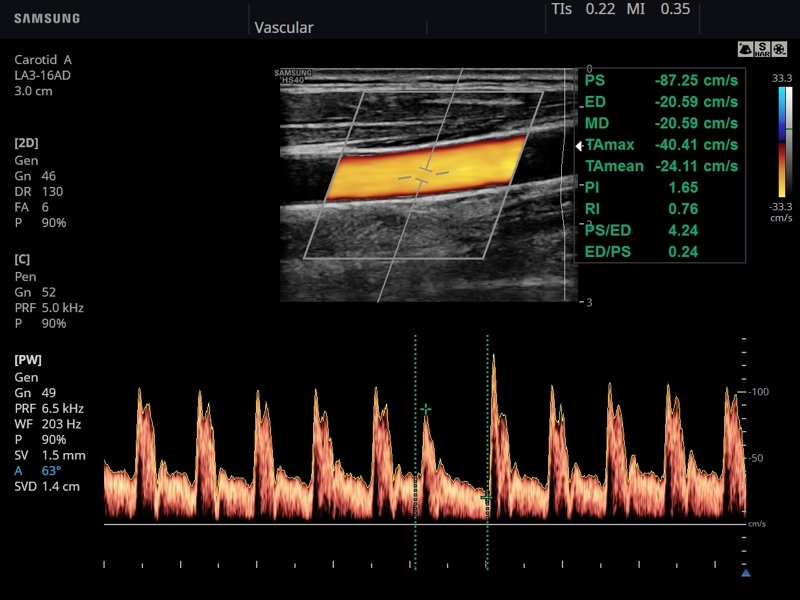 Common carotid artery, CFM & PW (echogramm №793)