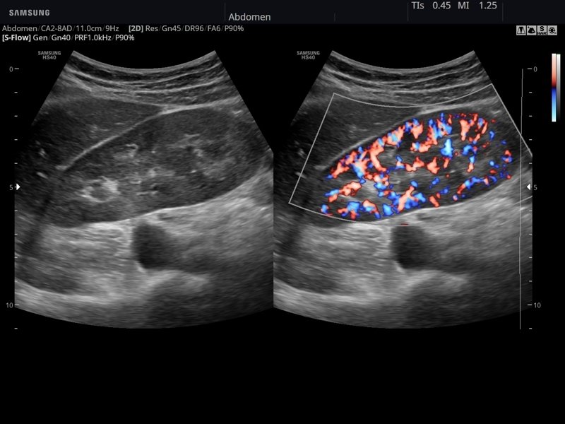 Kidney, S-Flow (echogramm №794)