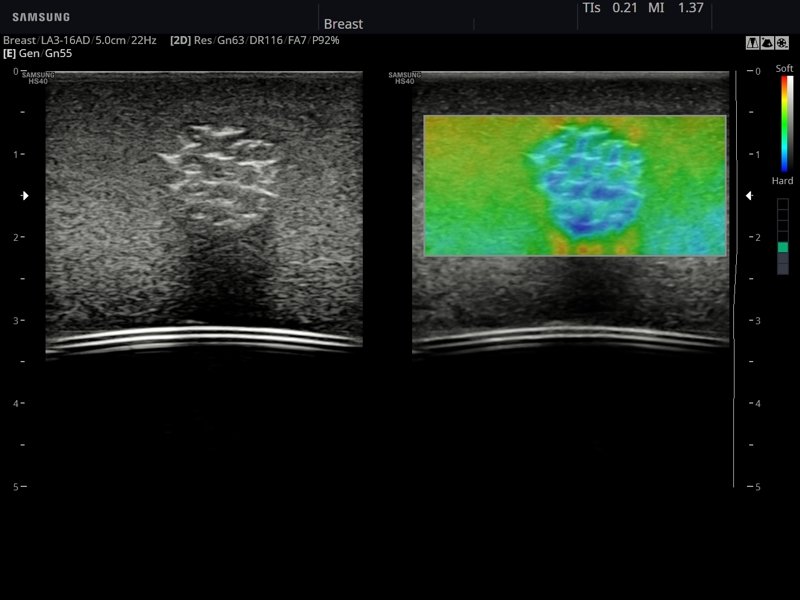 Breast (phantom), Elastoscan (echogramm №796)