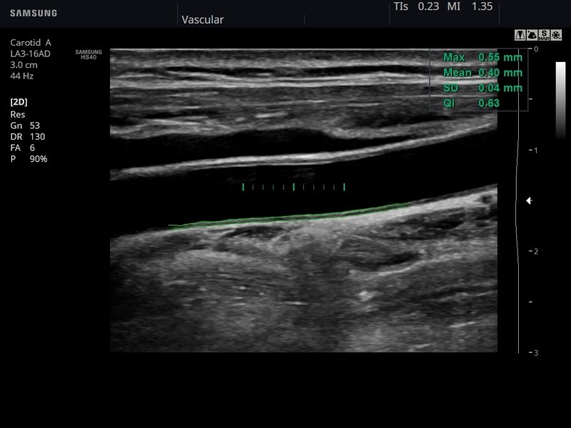 Common carotid artery, Auto IMT (echogramm №798)