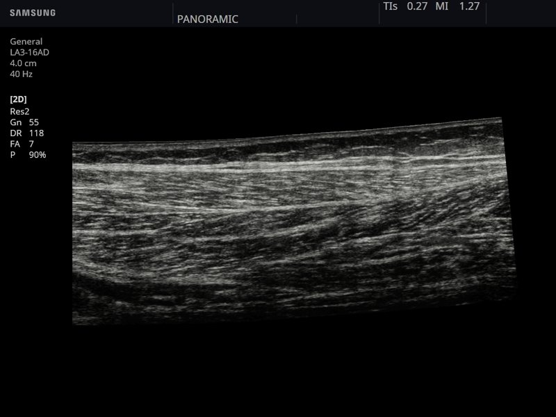 Gastrocnemius muscle, B-mode (echogramm №799)