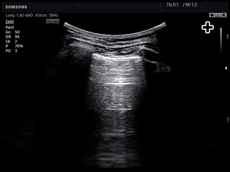 Lung (pleura), B-mode (echogramm №800)